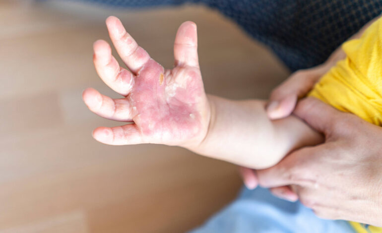 Menino de 2 anos sofre queimaduras por água quente no Bairro Boa Esperança