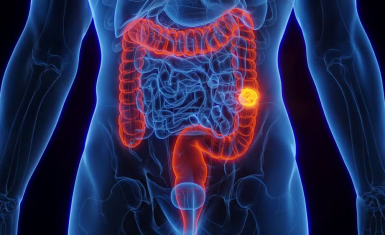 SUS passa a adotar novo exame para rastreamento do câncer de intestino