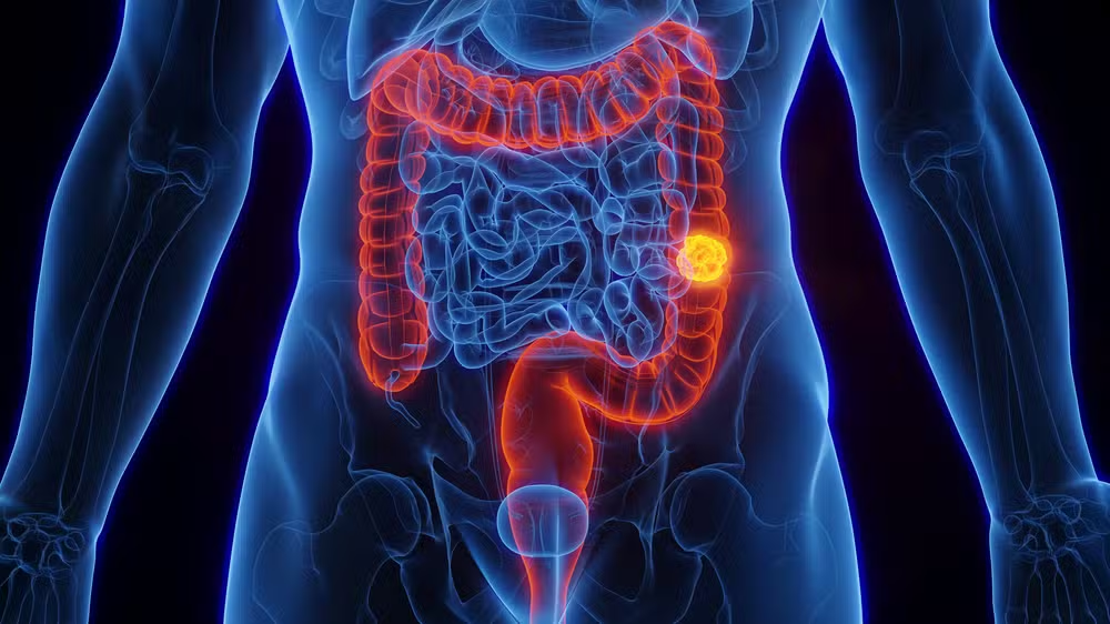 SUS passa a adotar novo exame para rastreamento do câncer de intestino