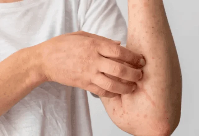 Ministério da Saúde confirma 81 casos de mpox no Brasil em 2026